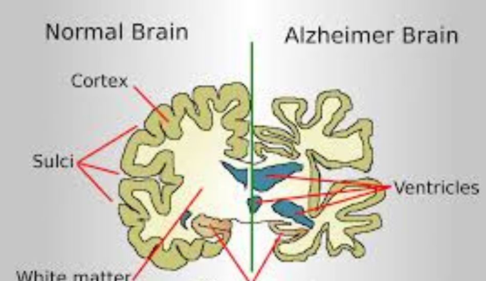 Alzheimer’s disease
